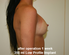 plastic-surgery-breast-augmentation